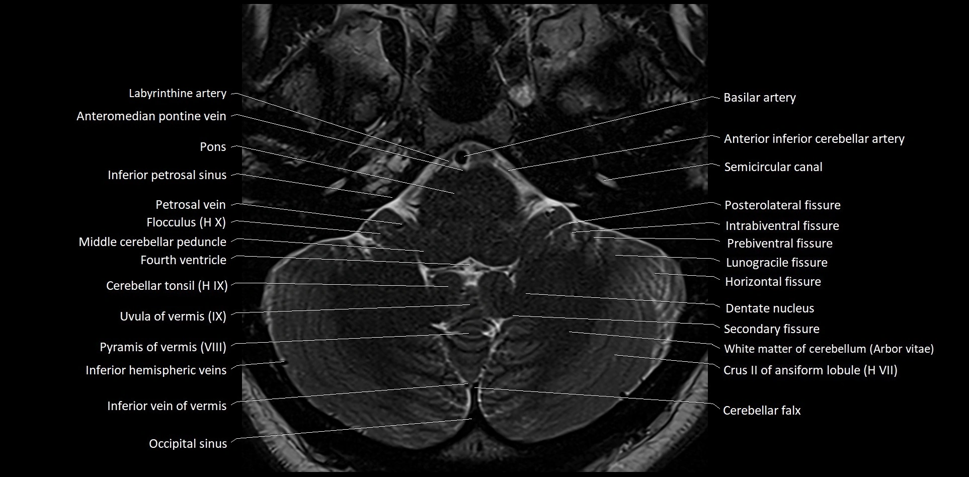 MRI Cerebellar anatomy High-resolution labelled 3T MRI image 10.webp